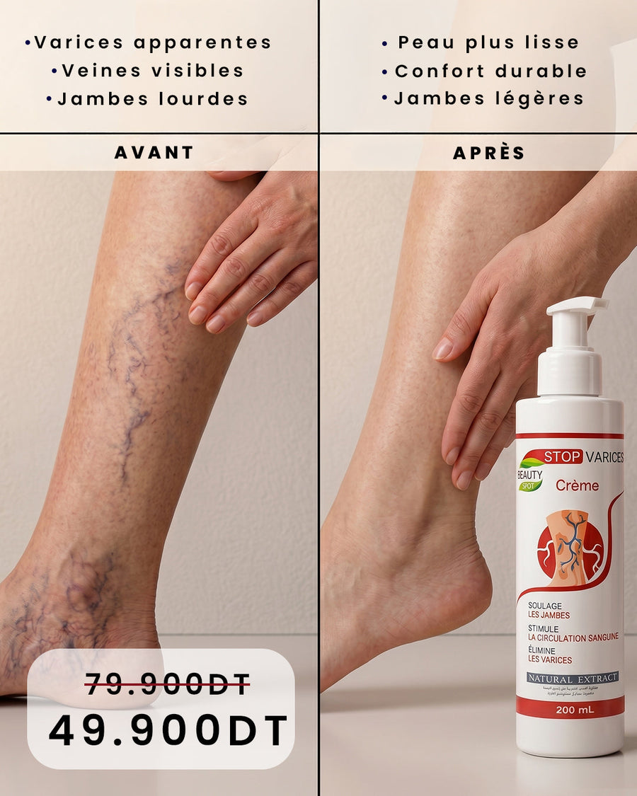 Stop Varices — avant/après (FR)