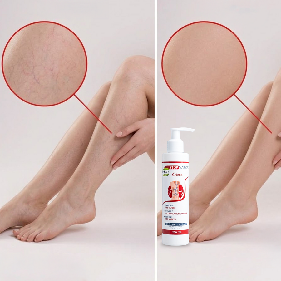 Stop Varices — كريم مضاد للدوالي 200ml